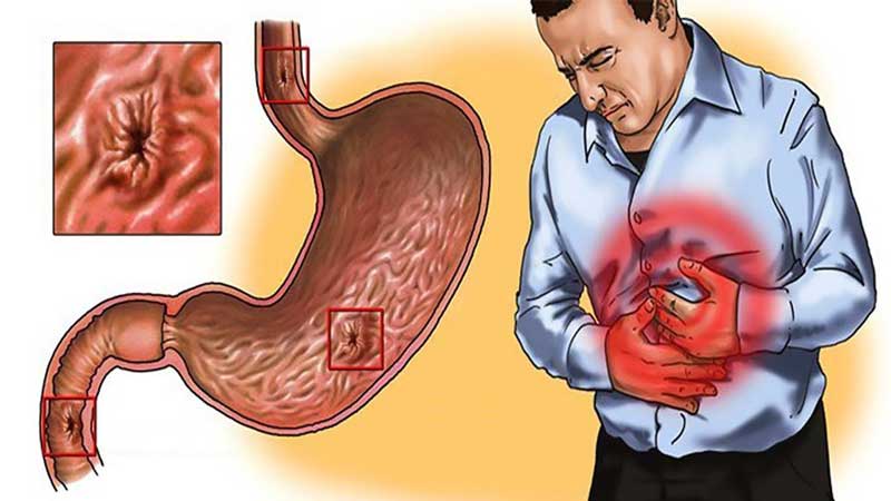 Ist es möglich, Rüben gegen Gastritis zu essen: Machen Sie sich mit Kontraindikationen vertraut und kochen Sie nach den besten Rezepten für einen schwachen Magen