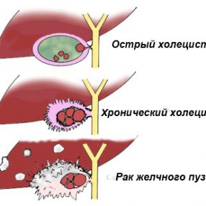 Ist es möglich, Wassermelone mit Cholezystitis und Pankreatitis zu essen