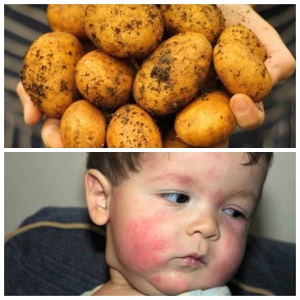 Wie manifestiert sich eine Kartoffelallergie bei Kindern und Erwachsenen?