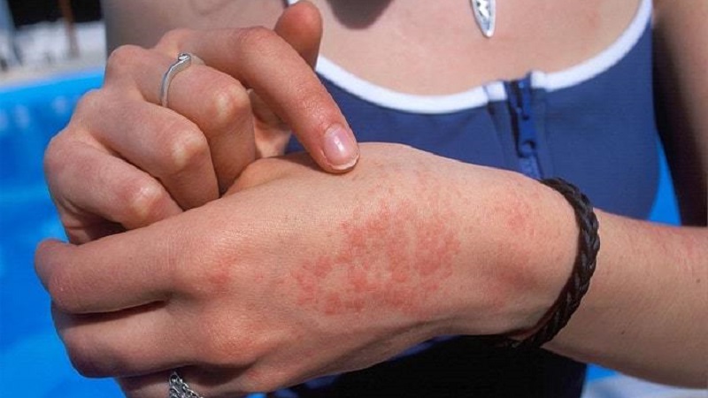 Wie manifestiert sich eine Kartoffelallergie bei Kindern und Erwachsenen?