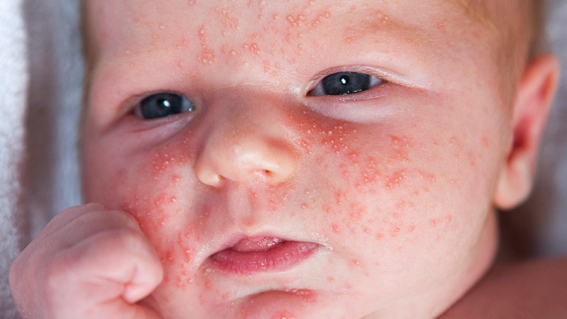 Sind Babys allergisch gegen Buchweizen?